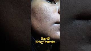 Day27 Using Tretinoin 0025 cream viralvideo tretinoin tretinoincream shorts youtubeshorts [upl. by Adilem320]