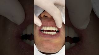 임플란트 세팅과정 dental dentist implantdentist dentalclinic implantdentistry [upl. by Zinck234]