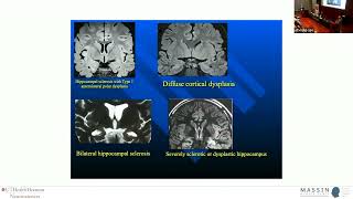 Drug Refractory Epilepsy  MASSIN Congress Day 3  Session 13 Talk 3 [upl. by Lerraf]