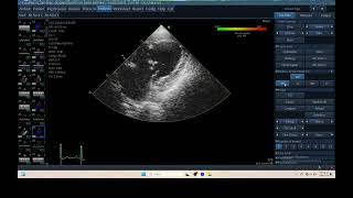 IQ 306 TSI TISSUE SYNCHRONY IMAGING ECHOPAC ANALYSIS ECHOCARDIOGRAPHY HEPATOMA PTE [upl. by Etnovaj]