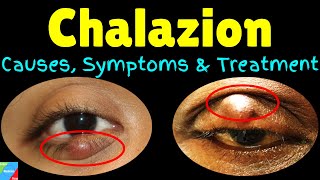 Chalazion Symptoms Causes Diagnosis Treatments amp Prevention  Eyelid Cyst  Meibomian Cyst [upl. by Clements]