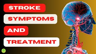 👉CAN WE PREVENT BRAIN HEMORRHAGE 【STROKE SYMPTOMS AND TREATMENT】 [upl. by Laure]