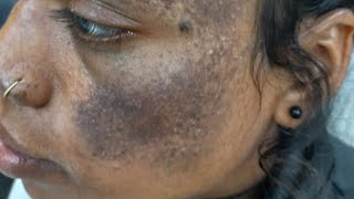 Birth mark क्यों होता है क्या ठीक हो सकता है कितना खर्चा कहां और कितनी बार करवाना पड़ेगा। [upl. by Mendel482]