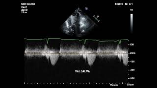 LVOT obstructionfalse amp true [upl. by Nautna]