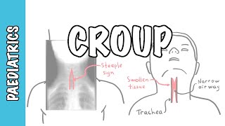 What is Croup larynotracheobronchitis  symptoms pathophysiology investigations treatment [upl. by Ordnagela10]