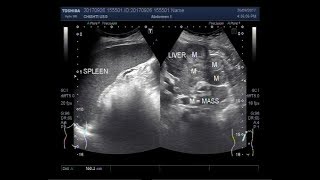 Ultrasound Video showing hepatic parenchymal disease with multiple masses and splenomegaly [upl. by Sullecram]