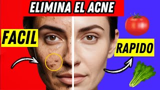 Como Quitar el Acné ¿Por Qué Algunas Personas Lo Sufren Más Que Otras belleza pielseca acne [upl. by Laks784]