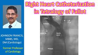 Right Heart Catheterization in Tetralogy of Fallot [upl. by Kela]