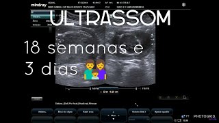 Ultrassom 18 semanas e 3 dias [upl. by Cirted]