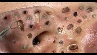 BLACKHEADS AND HIDDEN ACNE FOR THE ELDERLY [upl. by Eednar771]