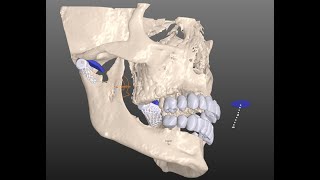 B4D Articulator Module [upl. by Otilesoj]