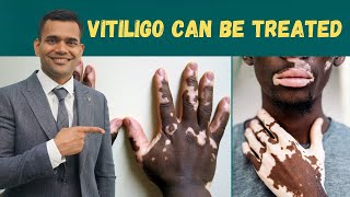 Vitiligo Leucoderma  Can Be Treated  Herbs And Vitamins To Treat Vitiligo  Dr Vivek Joshi [upl. by Llewol622]