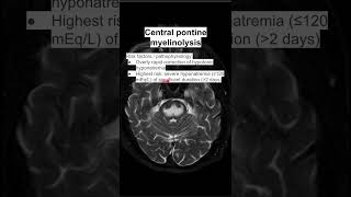 Central pontine myelinolysis [upl. by Reisfield]