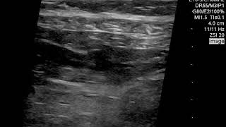 Transverse Abdominus Plane Block TAP Ultrasound 112020 [upl. by Adyl]