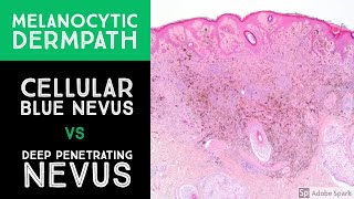 Melanocytic Dermpath Cellular Blue Nevus vs Deep Penetrating NevusMelanocytoma [upl. by Edson398]