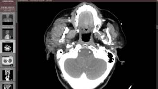 Parotitis with parotid duct stone [upl. by Gaves]