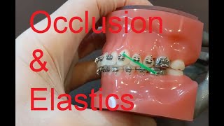 Occlusion amp Elastics [upl. by Namor]