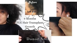 9 Months FUE Hair Transplant Growth Istanbul Turkey Longevita [upl. by Demetre179]