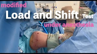 Modified Load and Shift Test Under Anesthesia  Shoulder Instability [upl. by Freya729]