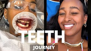 MY TEETH JOURNEY  I GOT PORCELAIN VENEERS  BEFORE AND AFTER PHOTOS  DR NEAL PATEL  THE YUSUFS [upl. by Gies]