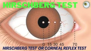 hirschberg corneal reflex tes  how to perform hirschberg test  hirschberg test explained [upl. by Kimball121]