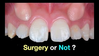 Solving Upper Impacted canines｜【Chris Chang Ortho】CC792 [upl. by Eenat]