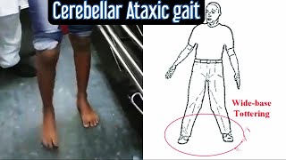 Cerebellar Ataxic Gait giving appearance of drunkenness [upl. by Samuele]