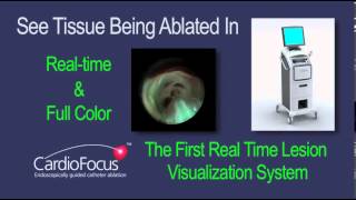 Visually Guided Ablation [upl. by Anima474]