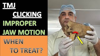 TMJ CLICKING JAW DEVIATION  WHEN TO GET TREATED [upl. by Nyledam]