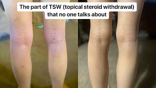 The part of TSW topical steroid withdrawal that no one talks about [upl. by Judd44]