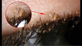 Worst head lice infestations ever Adult shows child how to get rid of head lice [upl. by Stanway]