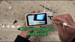 Anykit Digital Otoscope with Gyroscope Review [upl. by Deehan]