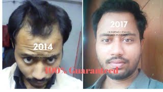 Regrow hair naturallyWith Video Proof2014 vs 2017 [upl. by Huckaby]