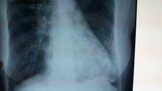 Bronchiectasis Chest Xray  What is bronchiectasis [upl. by Fabozzi]