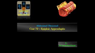 Ultrasound Case 72  Epiploic Appendagitis [upl. by Asirrak]