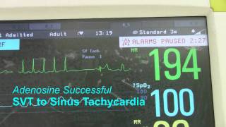 What are the treatment options for supraventricular tachycardia SVT [upl. by Oyek]