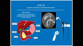 Palliative Care for End Stage Liver Disease [upl. by Sauncho]