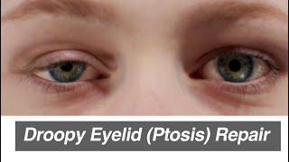 Droopy Eyelid Ptosis Repair [upl. by Aneekas909]