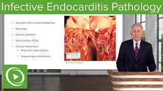 Infective Endocarditis IE Pathology – Infectious Diseases  Lecturio [upl. by Detta]