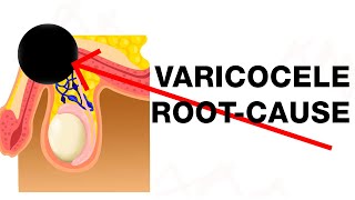 Varicocele Treat the RootCause [upl. by Bronny]