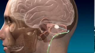 Deep Brain Stimulation for Stroke Recovery Animation [upl. by Nerual980]