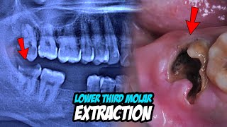 Molar Tooth Extraction Procedure  Dentist  Dokter Gigi Tri Putra [upl. by Stefania]