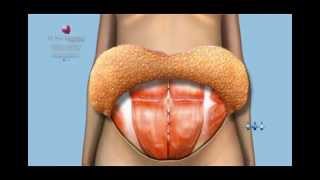 Cirugia Estetica del Abdomen Abdominoplastia Dr Juan Tommasino [upl. by Noakes]