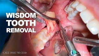 Wisdom tooth removal in 5 MIN or less Surgical Guide Online Course  Free eBook [upl. by Etnad]