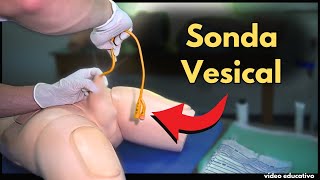 Colocación de Sonda Vesical en Hombres y Mujeres Guía Completa [upl. by Ociram]