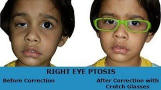 ocular myasthenia gravis treatment in hindi [upl. by Tecla]