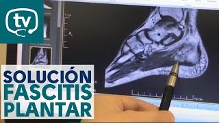 La solución para tratar la fascitis plantar [upl. by Sitoiyanap879]