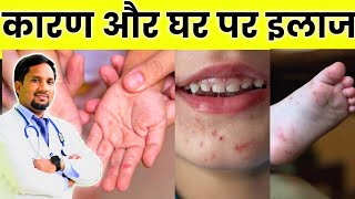 बच्चों के हाथ पैरों मुँह पर निकलने वाले दाने Hand foot mouth disease [upl. by Madora38]