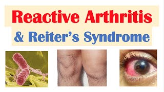 Reactive Arthritis amp Reiter’s Syndrome  Causes Signs amp Symptoms Diagnosis Treatment [upl. by Llenrap]