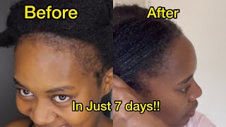 HOW I GOT MY HAIRLINE BACK IN 1 WEEK HAIR GROWTH  SAMUPERTY [upl. by Feeney193]